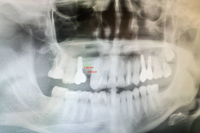 Bilbident radiografía de dientes