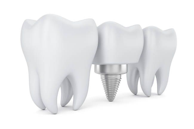 Bilbident implantes dentales